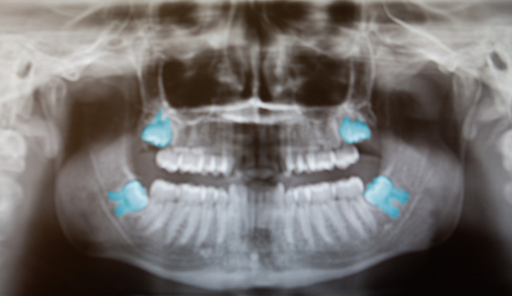 Wisdom teeth essay 08 picture