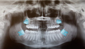 wisdom_teeth